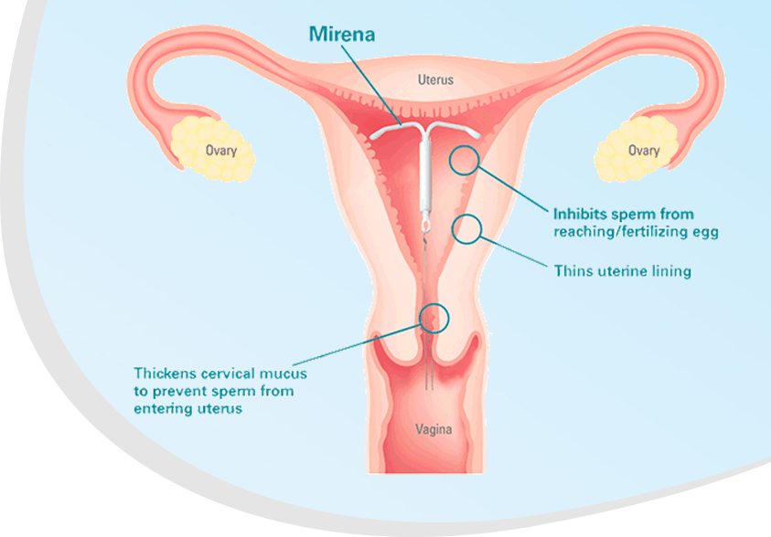 mirena graphic1 min
